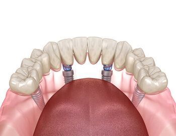 Dental Implant Bridge Featuring Four Titanium Posts Secured in the Jaw — Killara Dental in East Killara, NSW