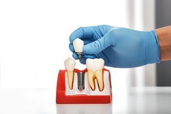 A Gloved Hand Holds a Dental Crown Above a Model Showing a Dental Implant — Killara Dental in East Killara, NSW