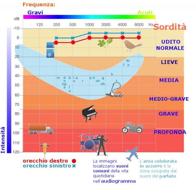 Audiogramma colorato con soglia uditiva per orecchio destro e sinistro, da normale a profonda