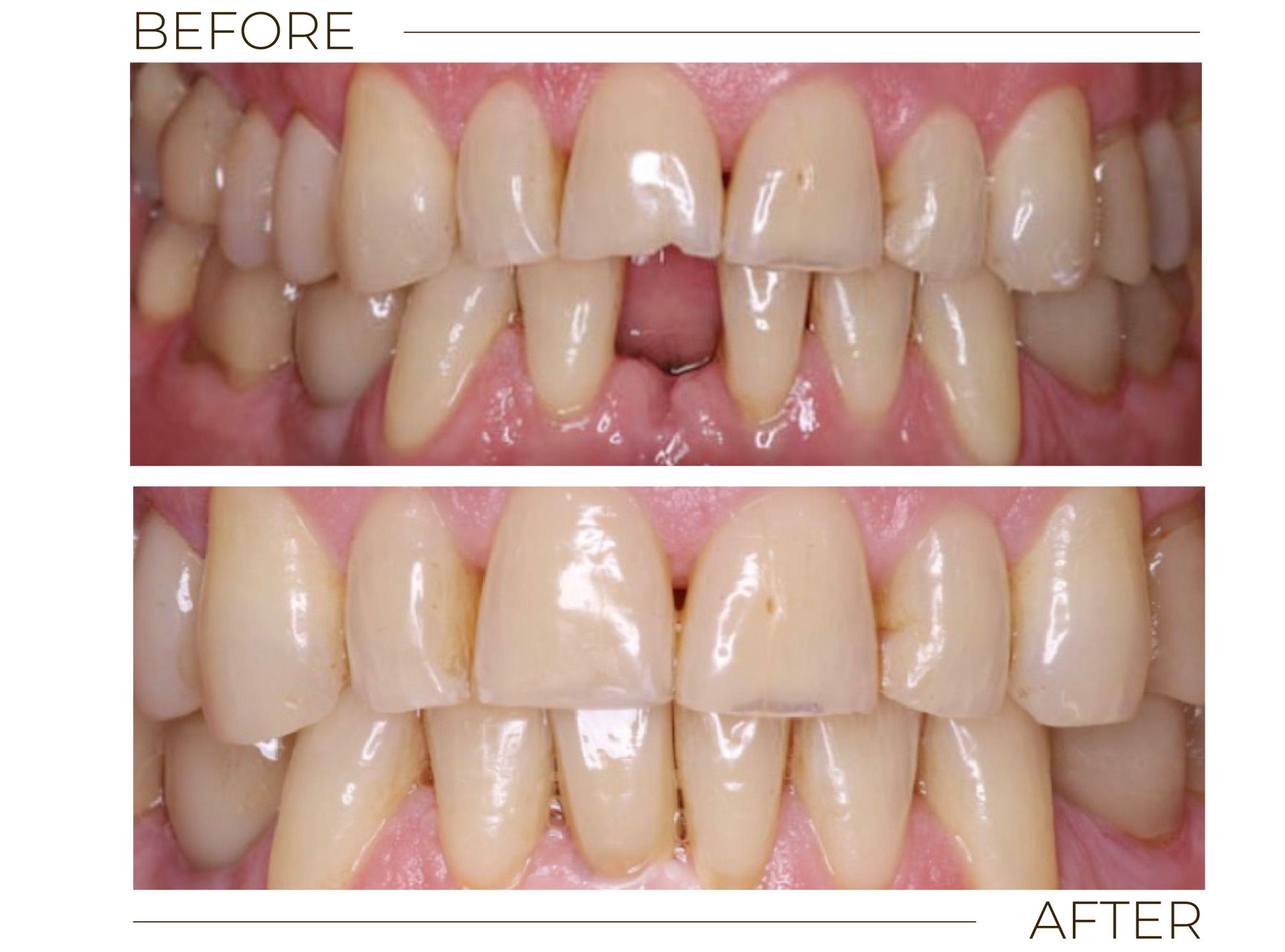Implant