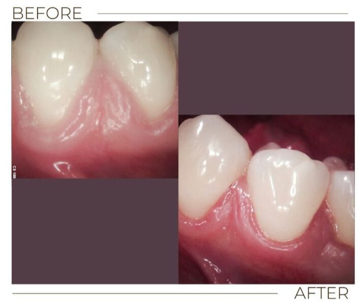 Gum Graft