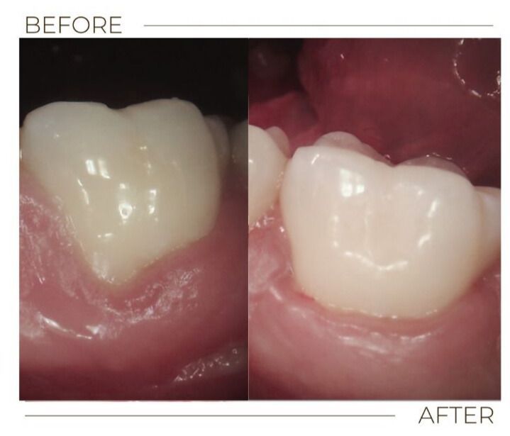 Gum Graft