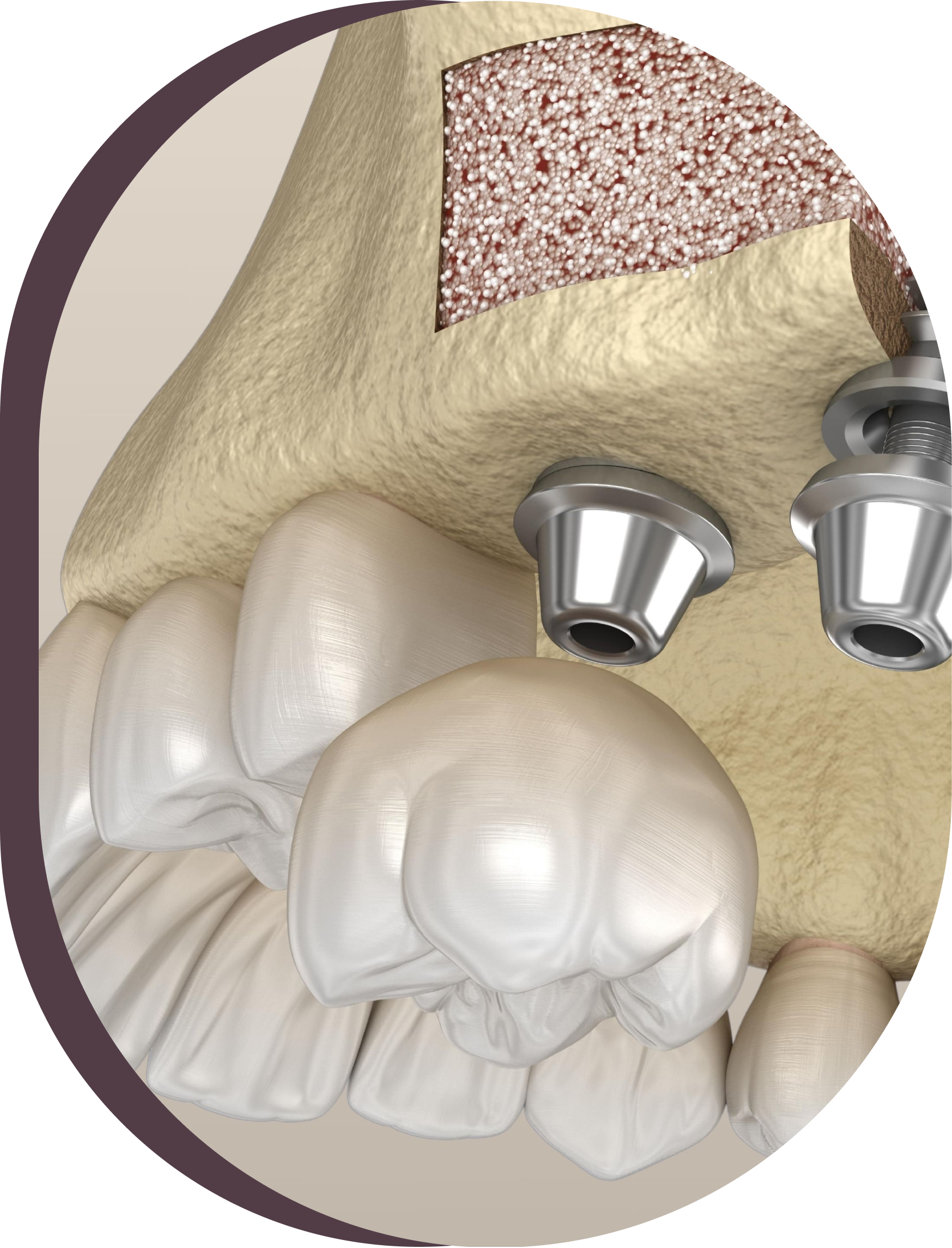 A close up of a sinus lift