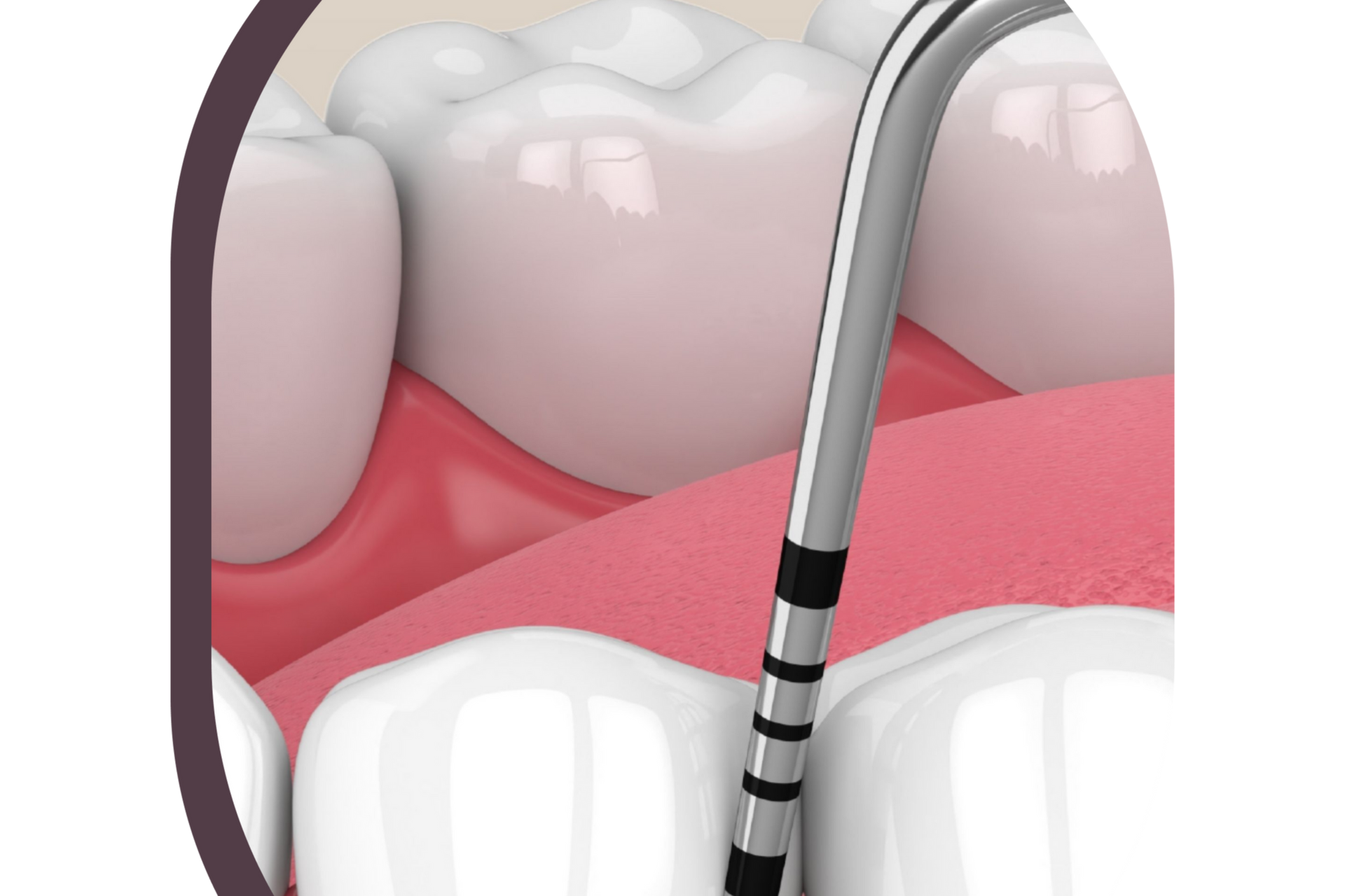Signs of Unhealthy Gums and When to See a Periodontist. MEasuring gums.