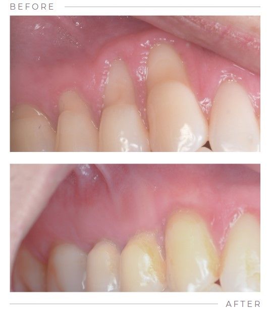 Gum Graft