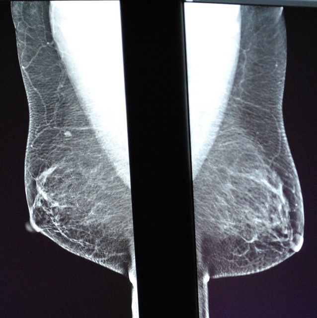 Side-by-side grayscale mammogram scans showing both breasts with black divider bars