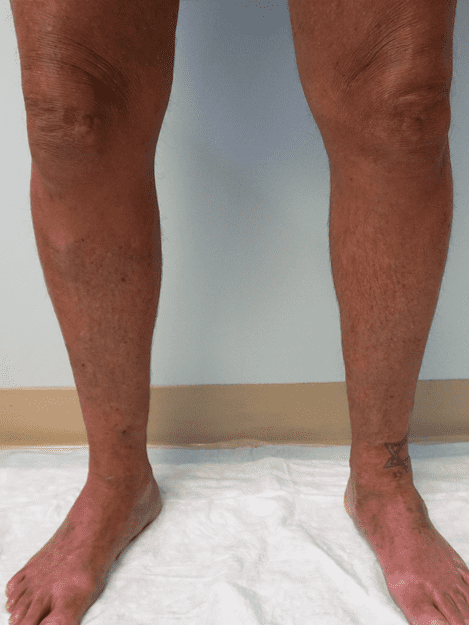 A close up of a person 's legs on a white towel.