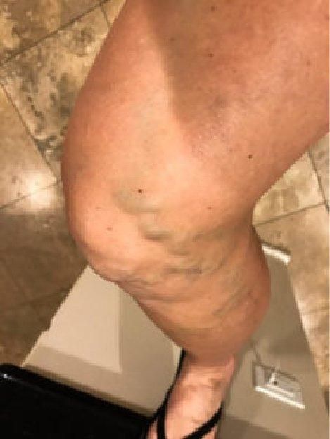 A close up of a person 's leg with veins on it.