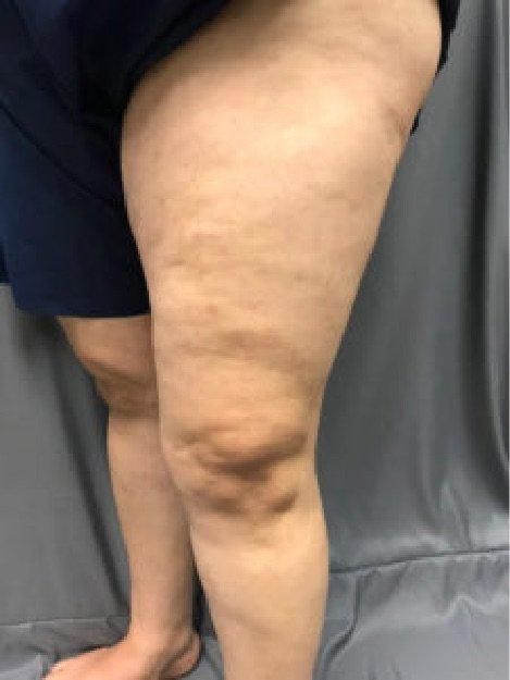 A woman 's legs are shown with a lot of cellulite on them.