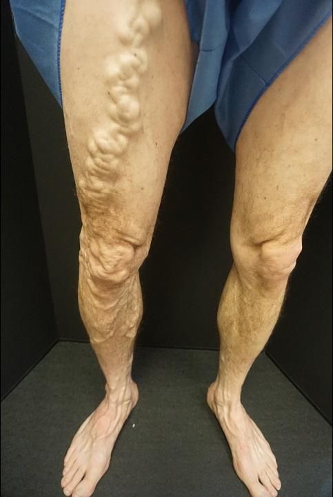 A person with varicose veins on their legs