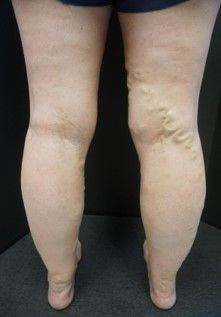 A close up of a person 's legs with varicose veins.