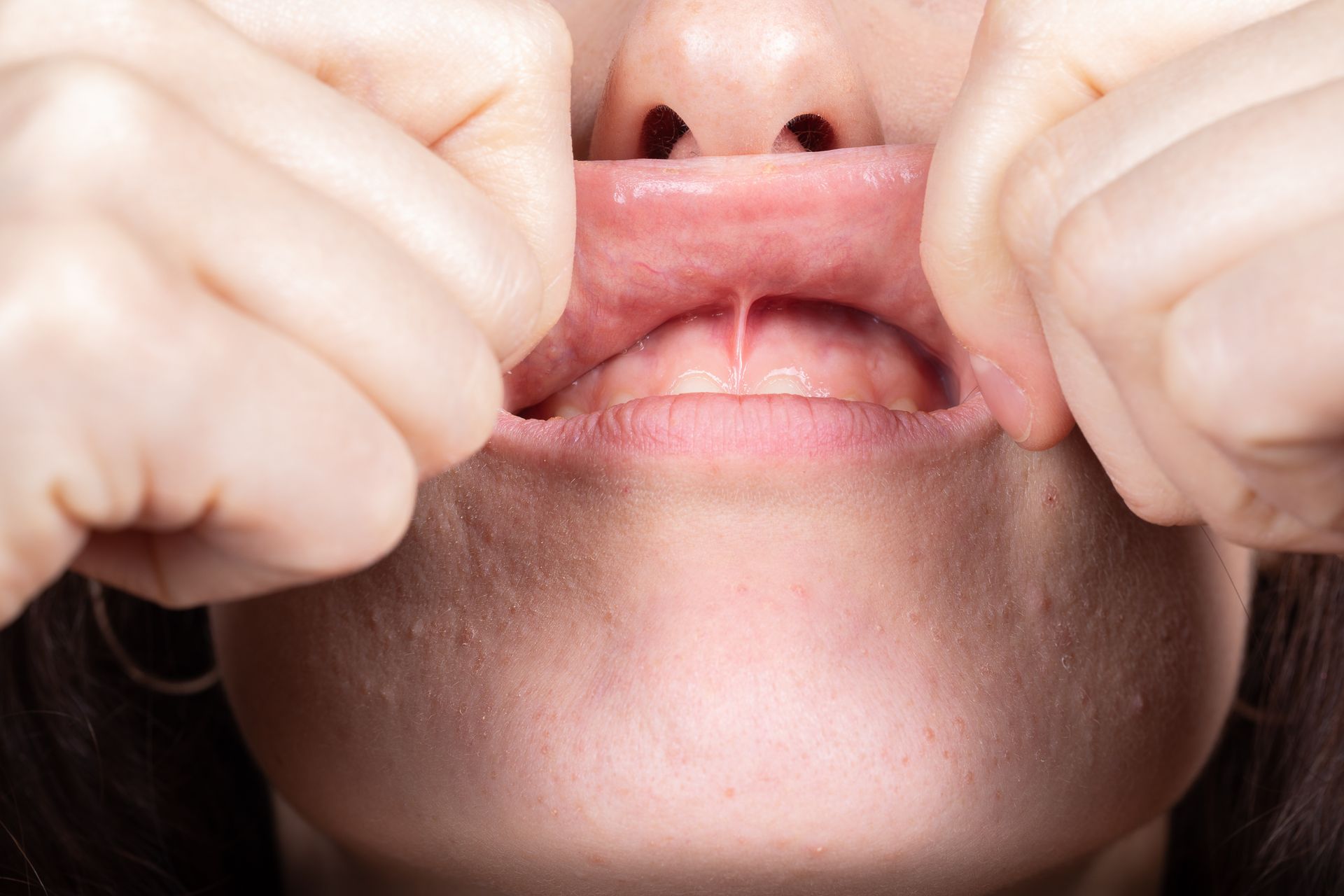 Mouth with raised upper lip, showing a visible frenulum, hands holding the lip up.