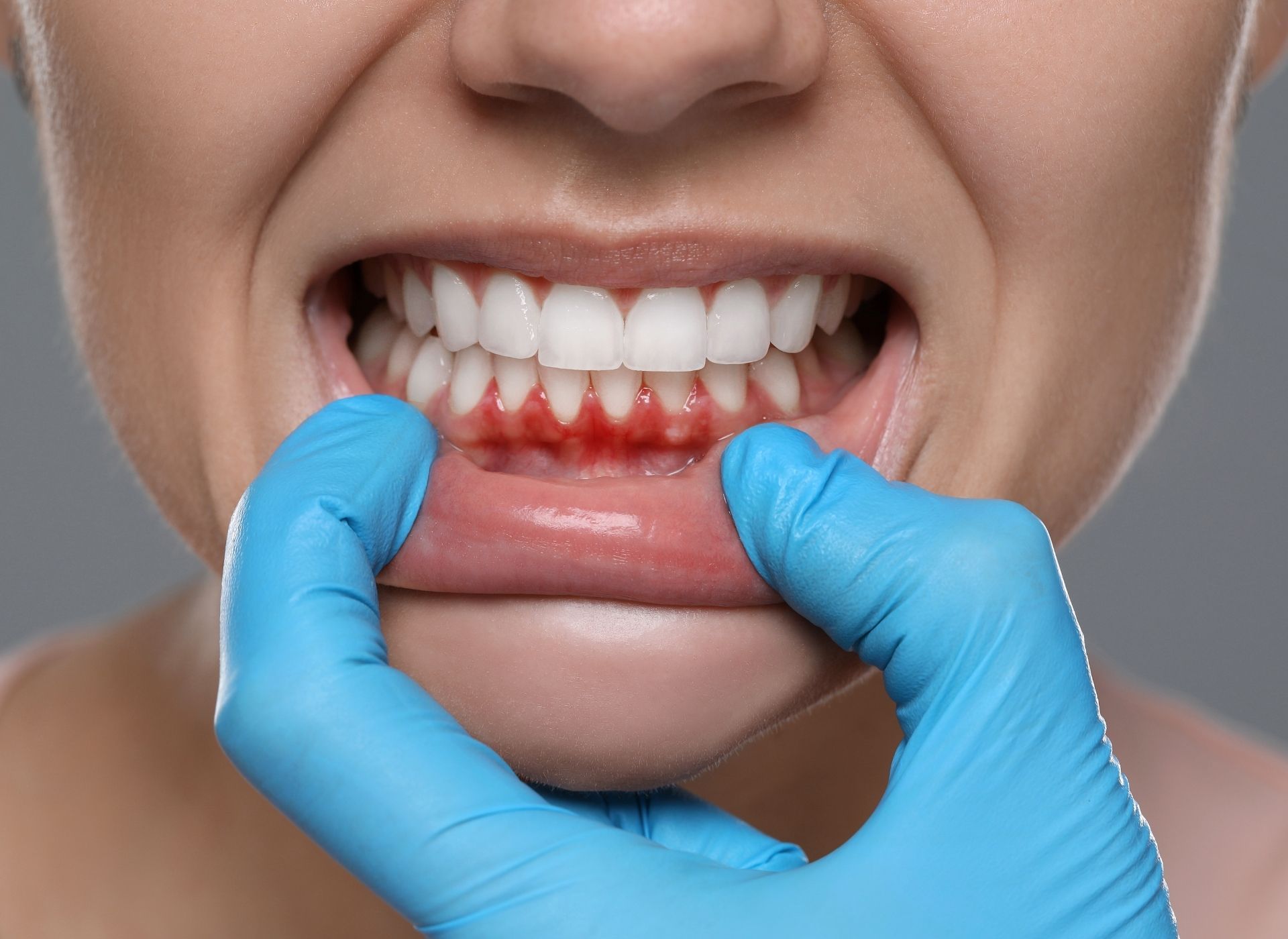 Mouth with inflamed gums; a gloved hand pulls down the lip. The gums are red and swollen.