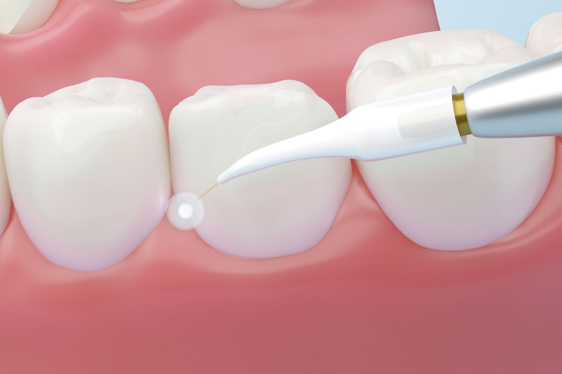 Tooth extraction: Dentist's gloved hand holding dental pliers with extracted tooth. Patient in background.