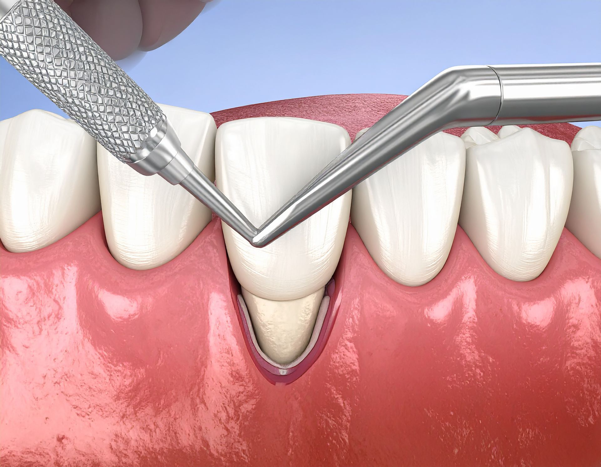 Dental work in progress. Dentist using a drill on a patient's teeth.