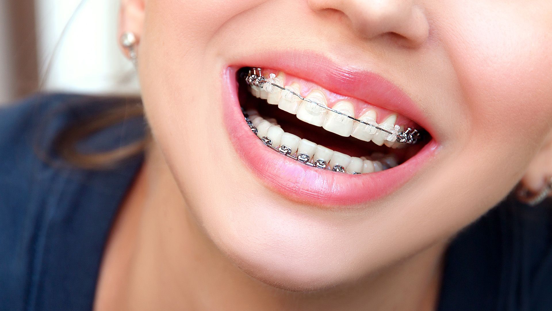 After Braces Care: A Complete Guide to Protecting Your New Smile