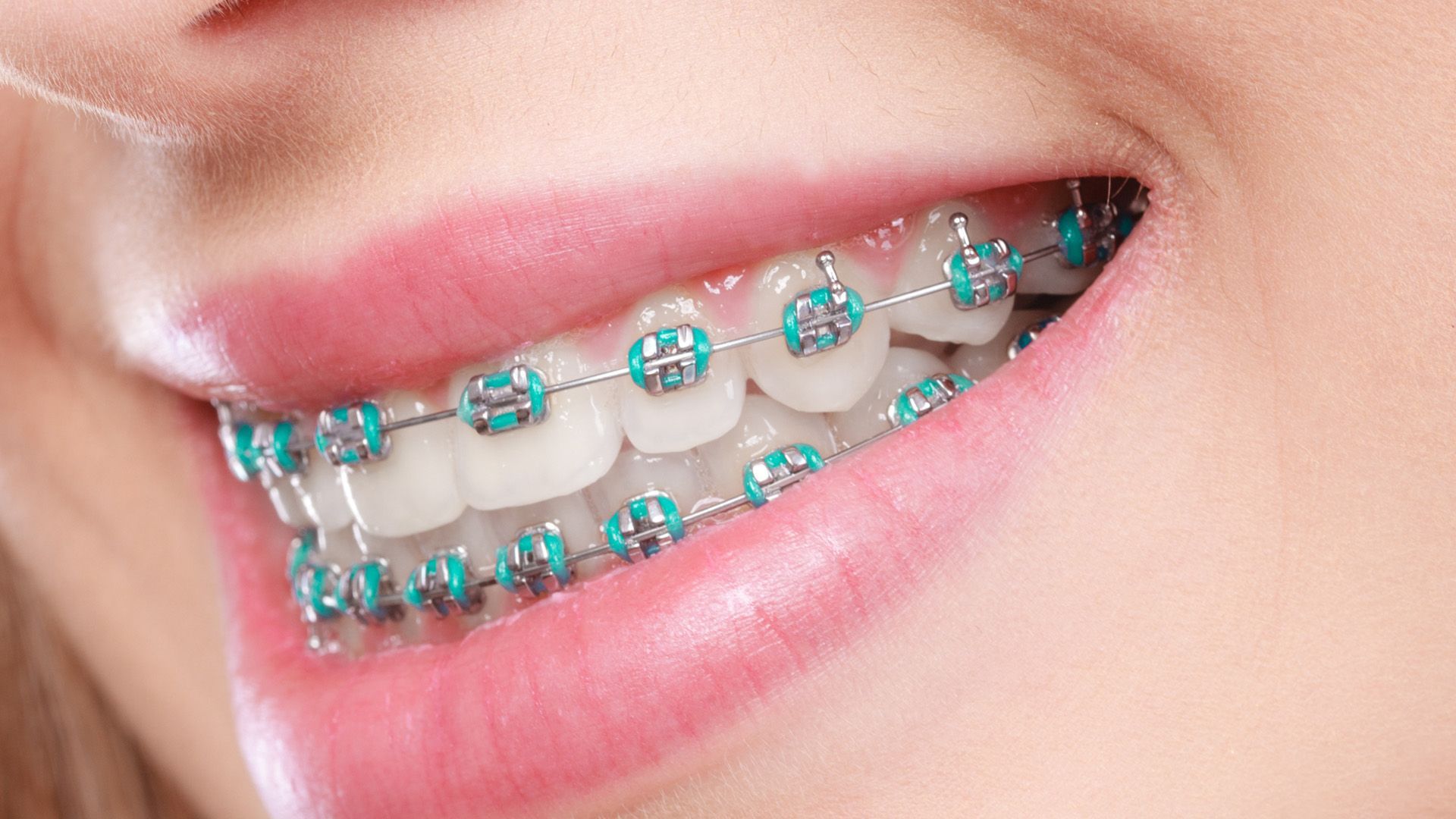 Bracing teeth, brackets for teeth