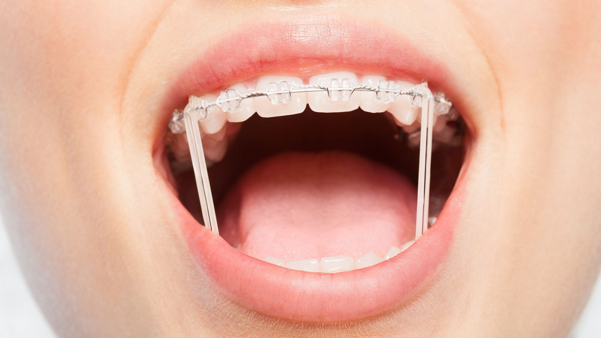 How Often Should You Should Change Your Rubber Bands on Braces
