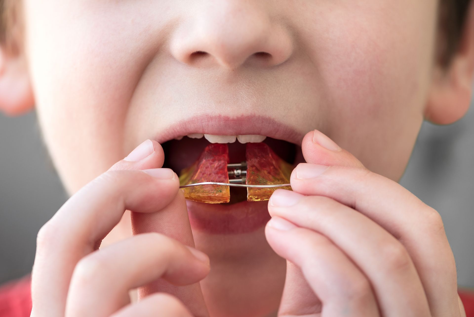 What to Do if Your Retainer Doesn’t Fit Anymore