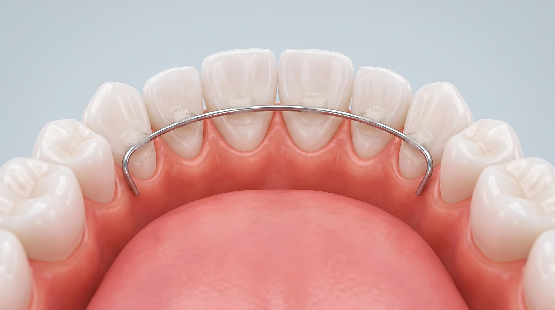 What to Do If Your Permanent Retainer Comes Off