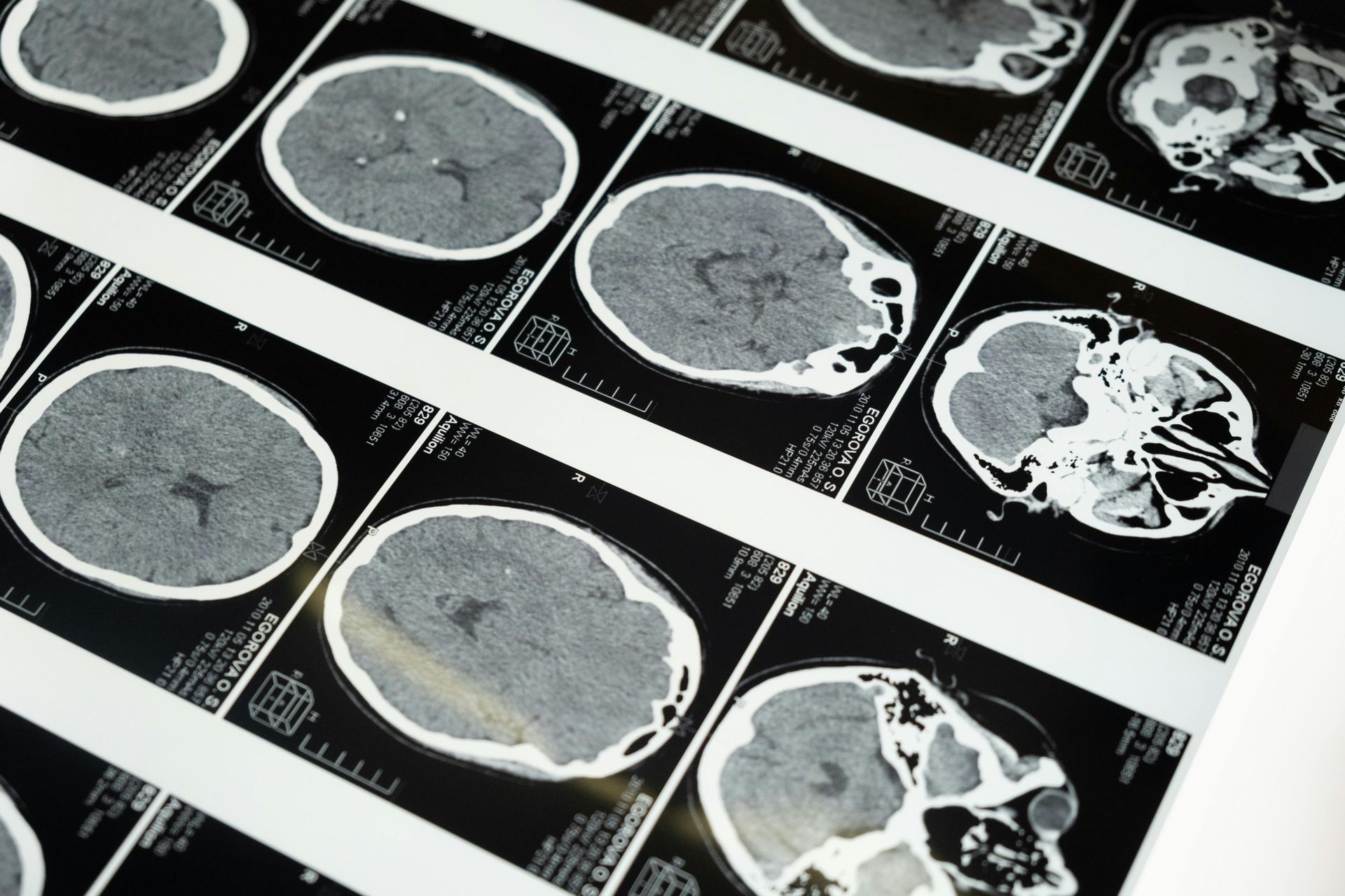 CT scans of a human brain on a light table, showing cross-sections of the head.