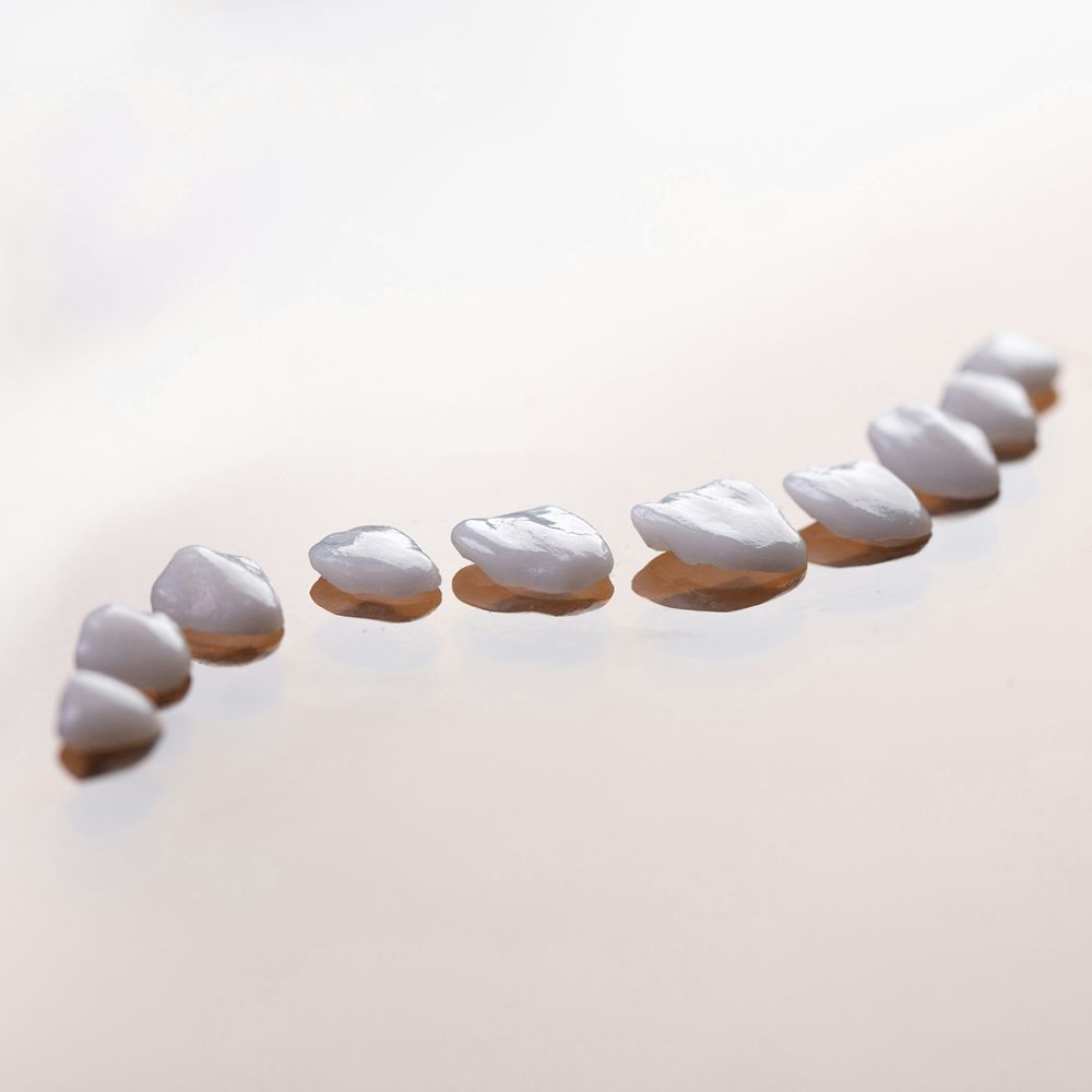 Faccette dentali estetiche per migliorare forma e colore