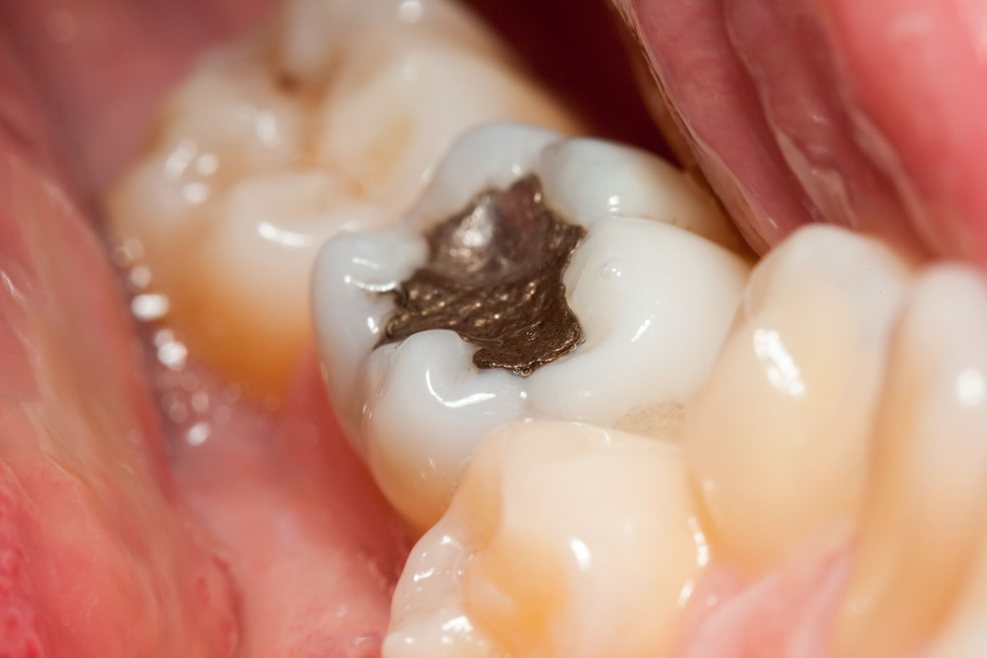 Otturazioni in Amalgama otturazioni in argento, amalgama di argento, cura delle carie, carie dentale