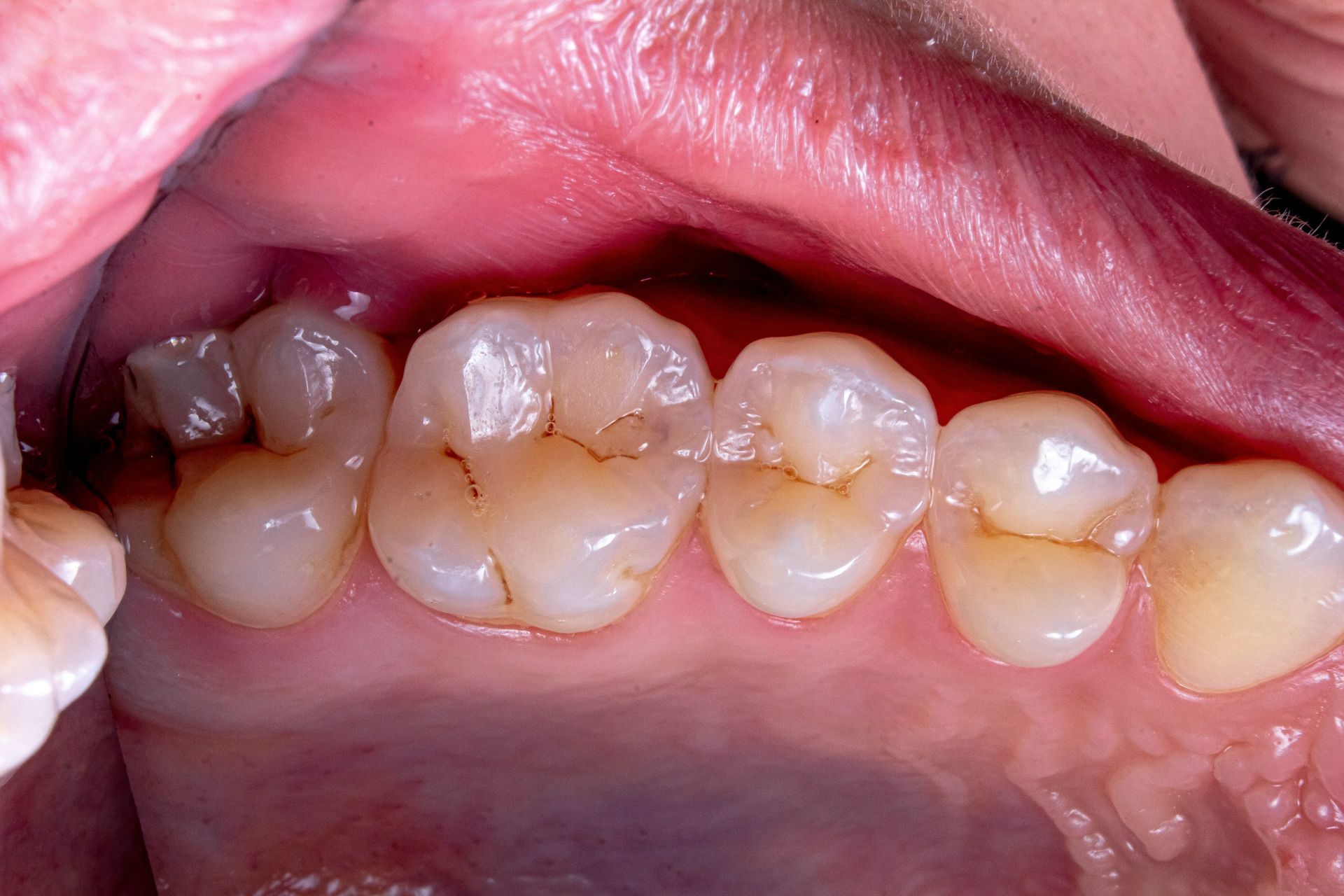 Cari dentali Carie dentale, mal di denti, cura della carie, dentista vicino a me