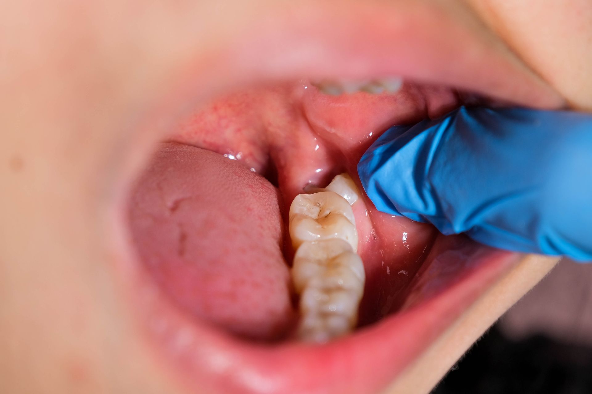 dente del  giudizio dolore gengiva, guancia gonfia 