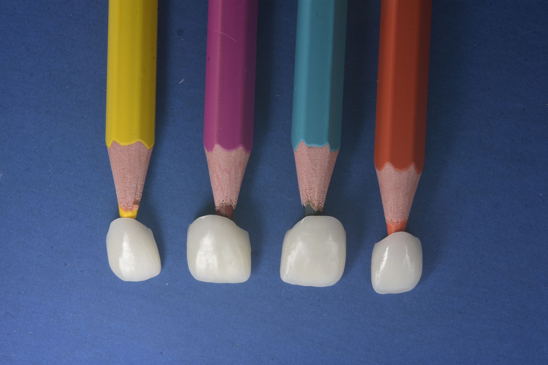 Faccette dentare sottilissime