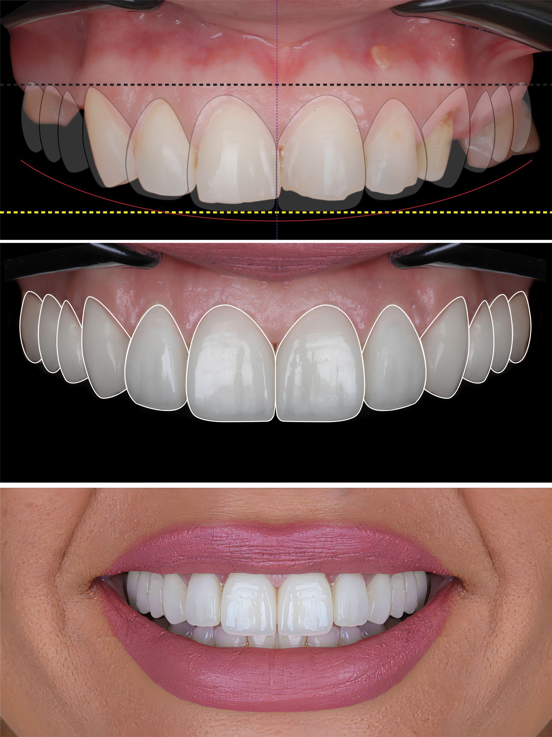 Faccette Dentali sottilissime