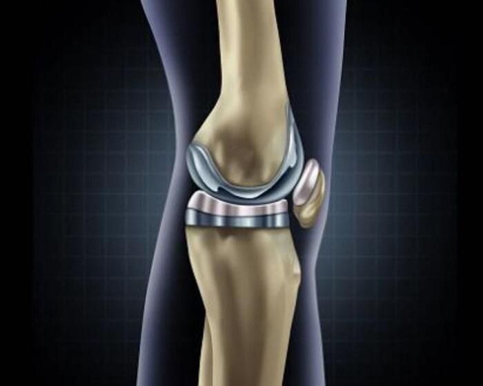 DR. GILBERTO VELA RODRÍGUEZ - PRÓTESIS DE RODILLA