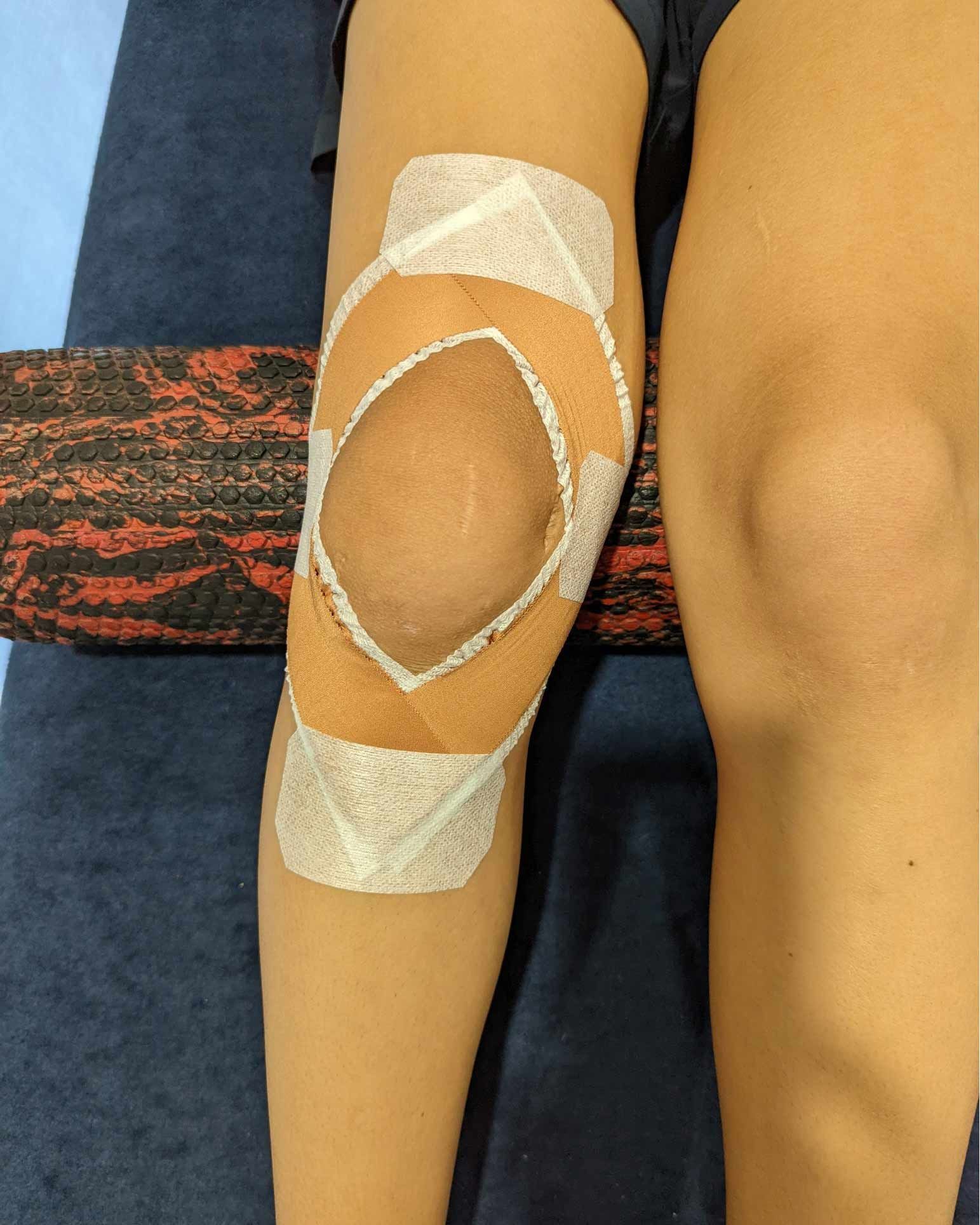 Individual Sporting a Knee Bandage, Embodying a Commitment to Physical Well-Being — Return to Performance Physiotherapy in Epsom, VIC