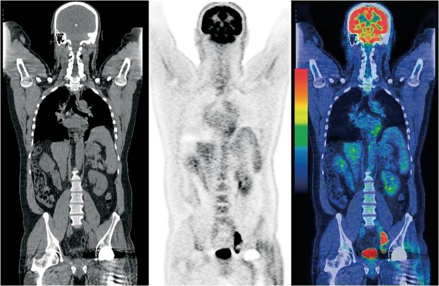 Three medical scans of the torso, including grayscale, PET, and color heatmap views side by side.