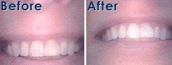 Before and After Whitening - Galloway, NJ - Asuncion Family Dental