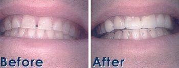 Before and After Veneers - Galloway, NJ - Asuncion Family Dental