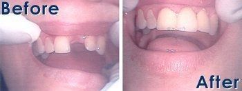 Before and After Bridgework - Galloway, NJ - Asuncion Family Dental