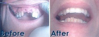 Client Before and After - Galloway, NJ - Asuncion Family Dental