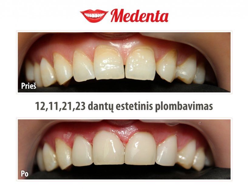 plombavimas