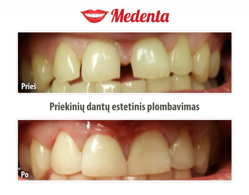 plombavimas
