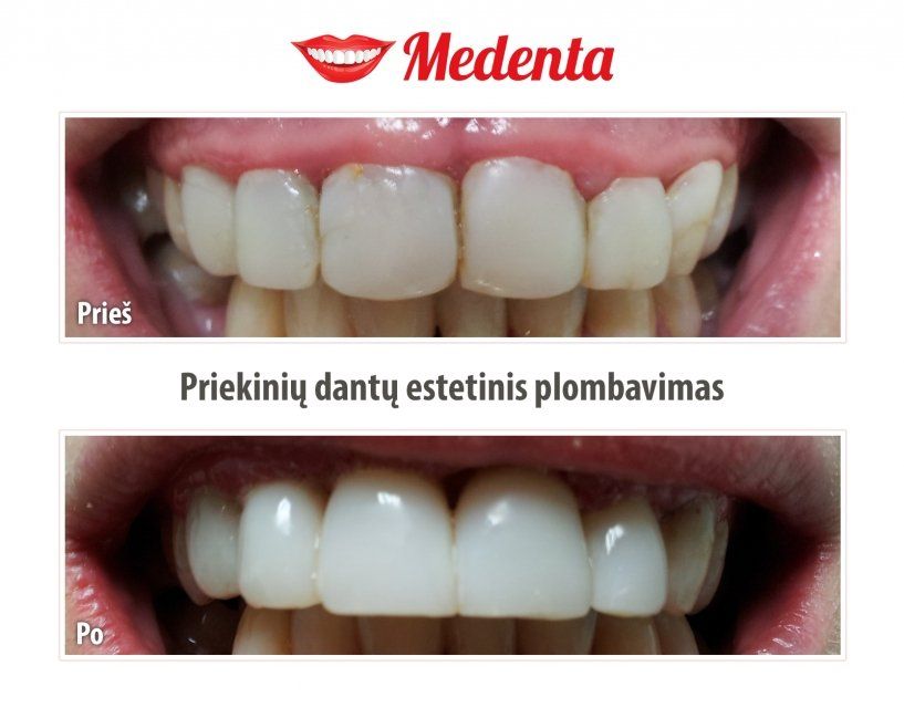 plombavimas