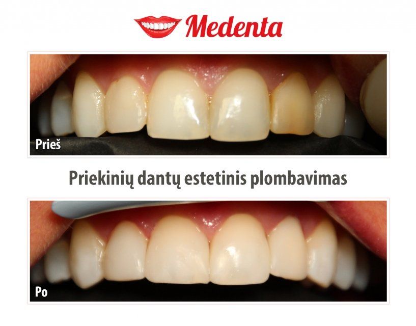plombavimas