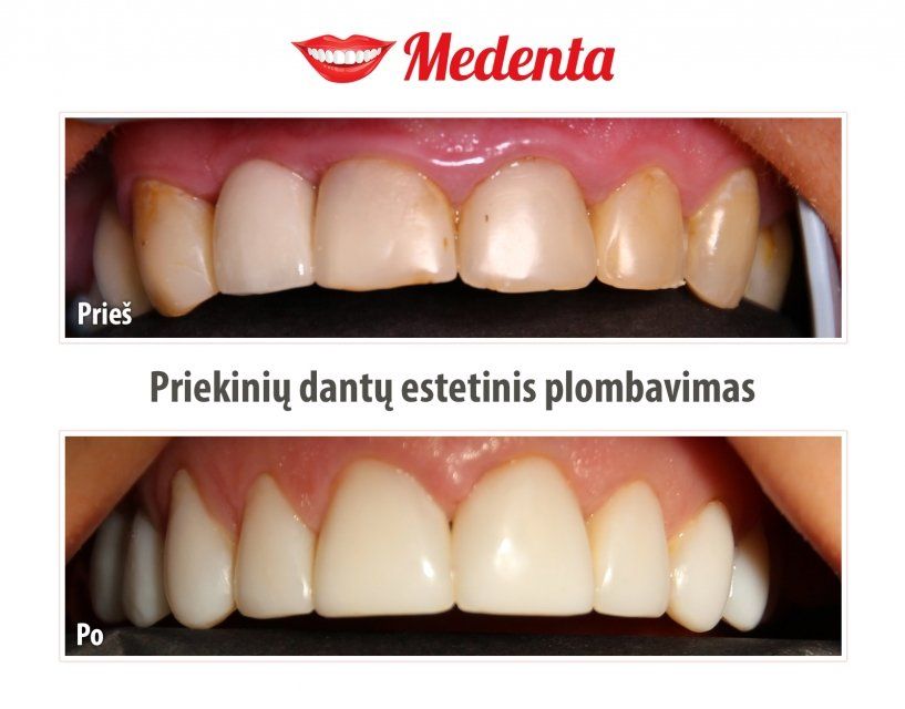 plombavimas