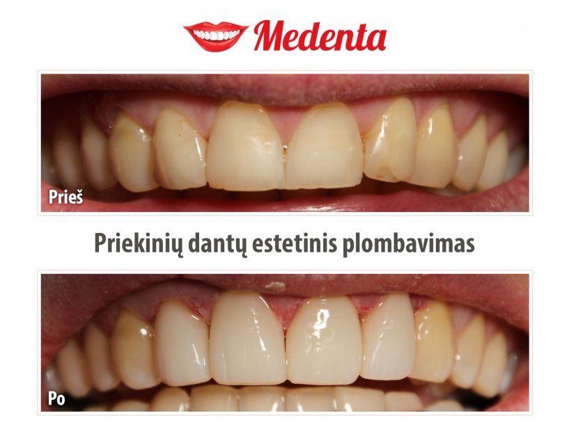 plombavimas