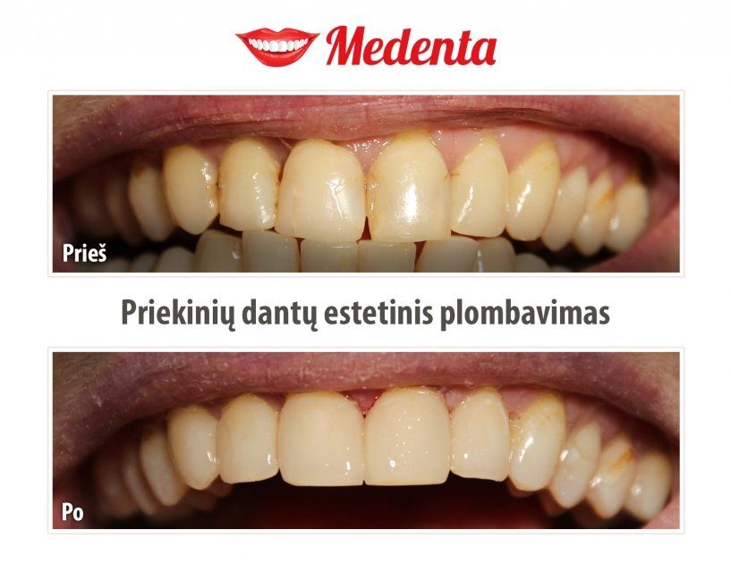 plombavimas