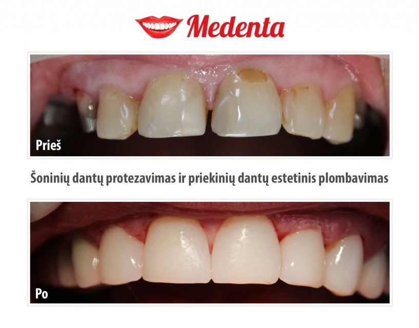 plombavimas