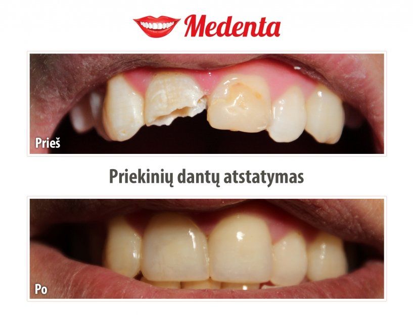 plombavimas