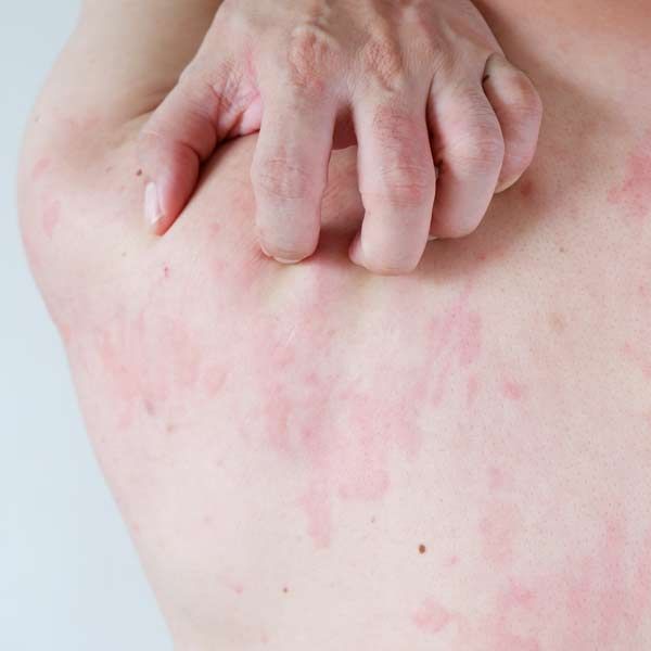 Symptoms for Alpha-Gal Syndrome