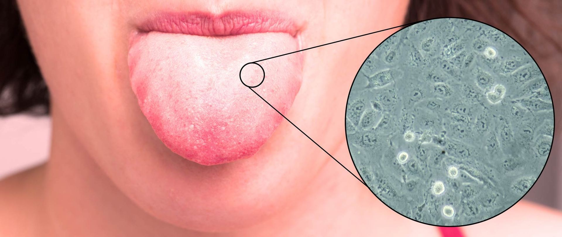 A close-up of a woman's tongue sticking out, infected with Candida natural remedies