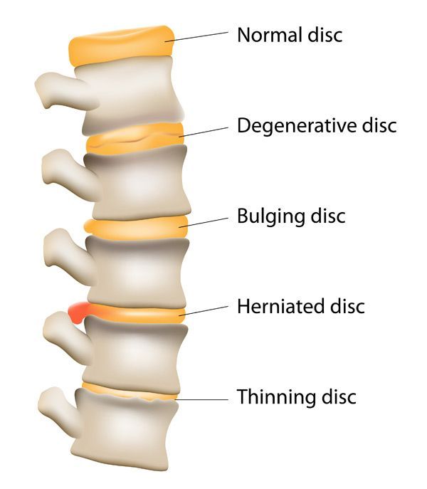 Degenerative Disc Disease